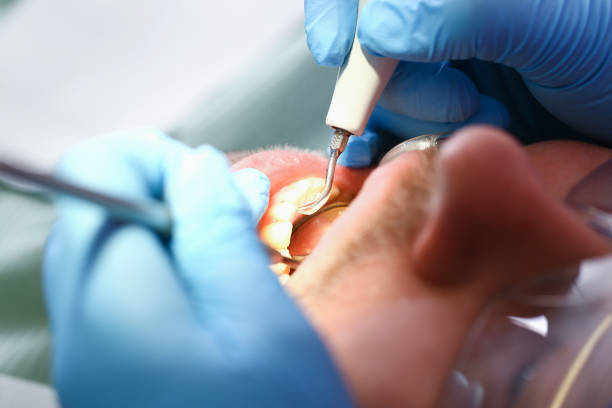 Best Chipped Tooth Repair Near Me  in Cupertino, CA