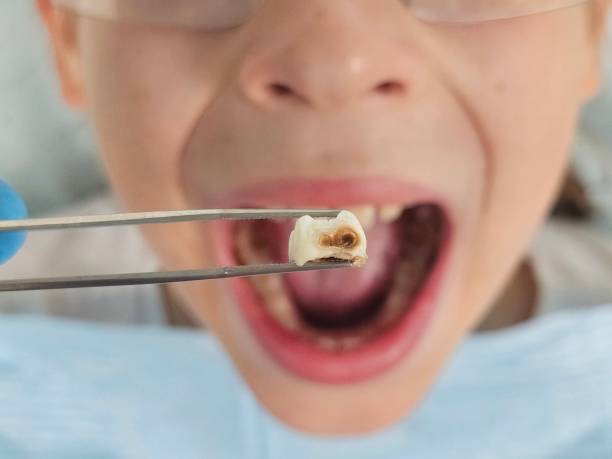 Best Dentist for Tooth Abscess  in Cupertino, CA